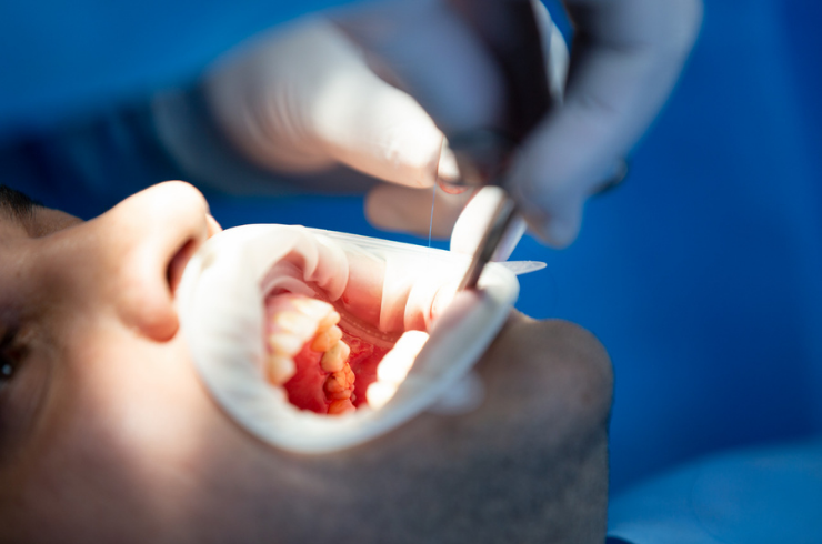 Root Canal Treatment (RCT)
