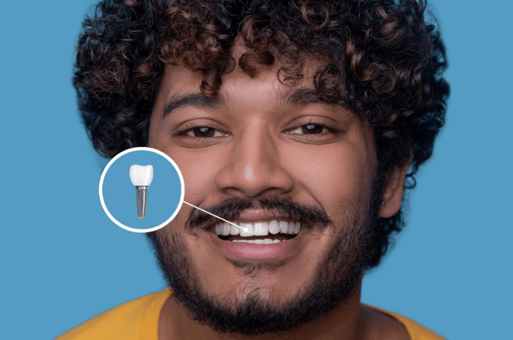 Dental Implants