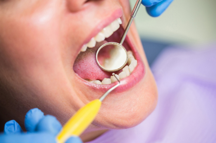 Dental Fillings